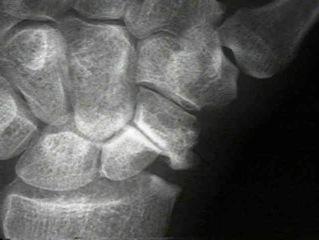 Scaphoid Nonunion